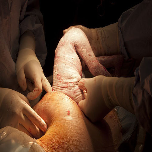 Cesarean Section Operation